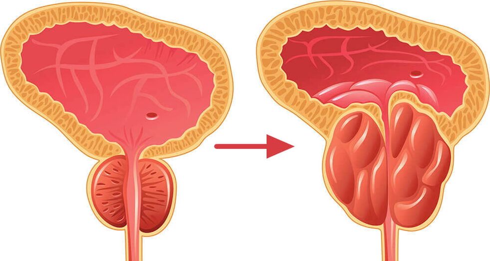 Glándula prostática - normal e inflamada