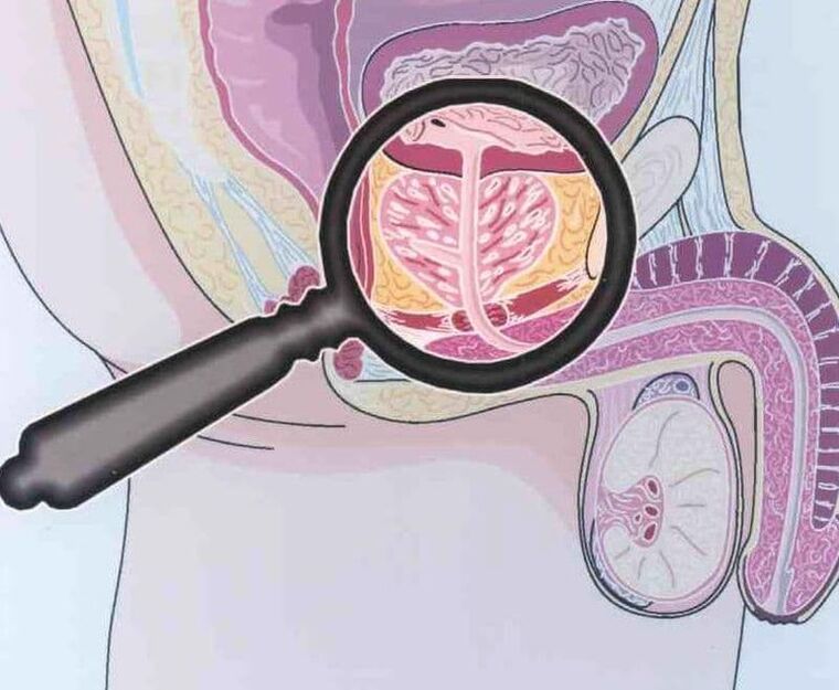 Derrota do tecido prostático en pacientes con prostatite crónica homes