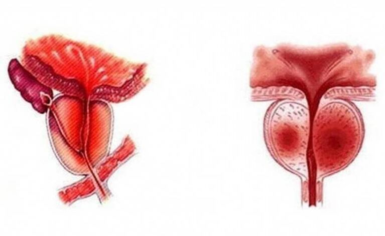 Inflamación aguda da glándula prostática, que pode chegar a ser crónica